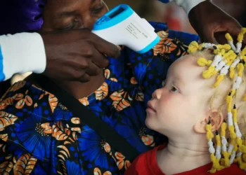 Médicos angolanos levam conforto a centenas de albinos no Bié
